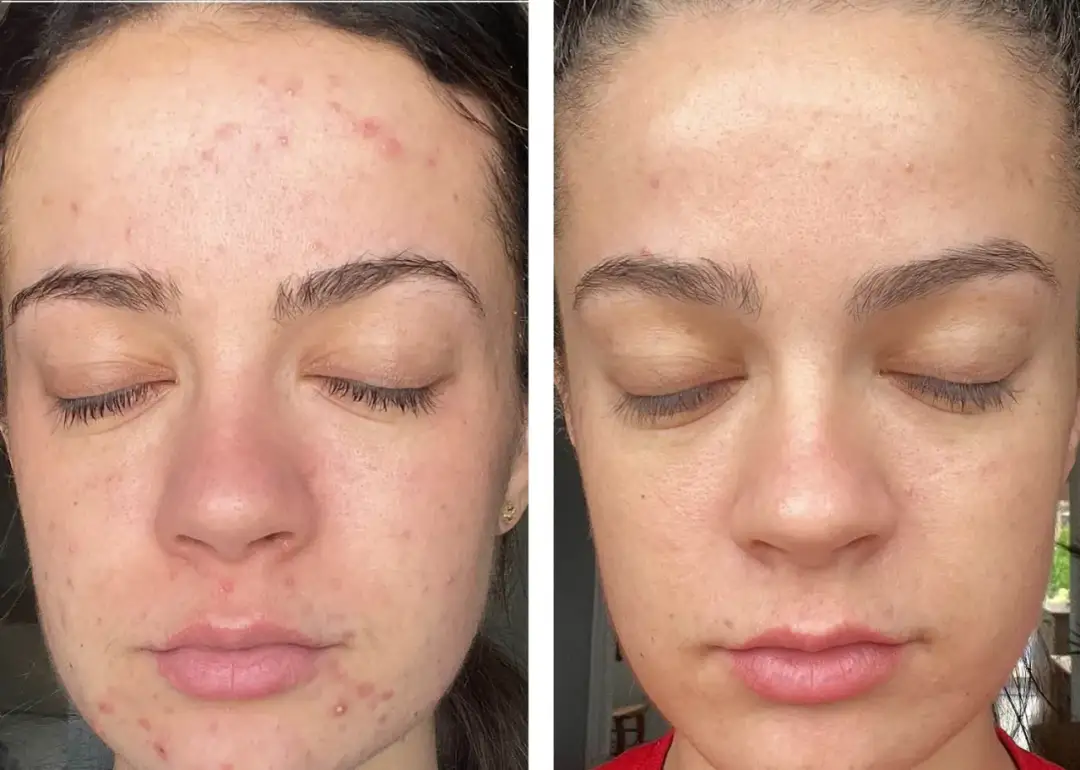 Co daje peeling enzymatyczny? Korzyści, efekty i dla kogo jest najlepszy