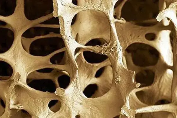 Quién descubrió la osteoporosis y su impacto en la salud ósea