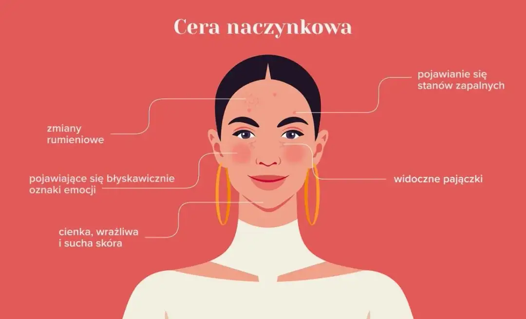 Cera naczynkowa: 7 objawów, które musisz znać - Poradnik