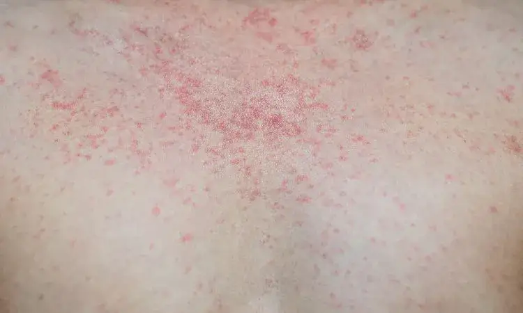 Rumień nagły u dorosłych objawy - jak je rozpoznać i leczyć