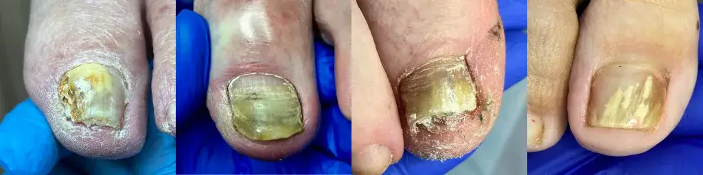 Gdzie zrobić badanie mykologiczne paznokci, aby szybko wyleczyć grzybicę?