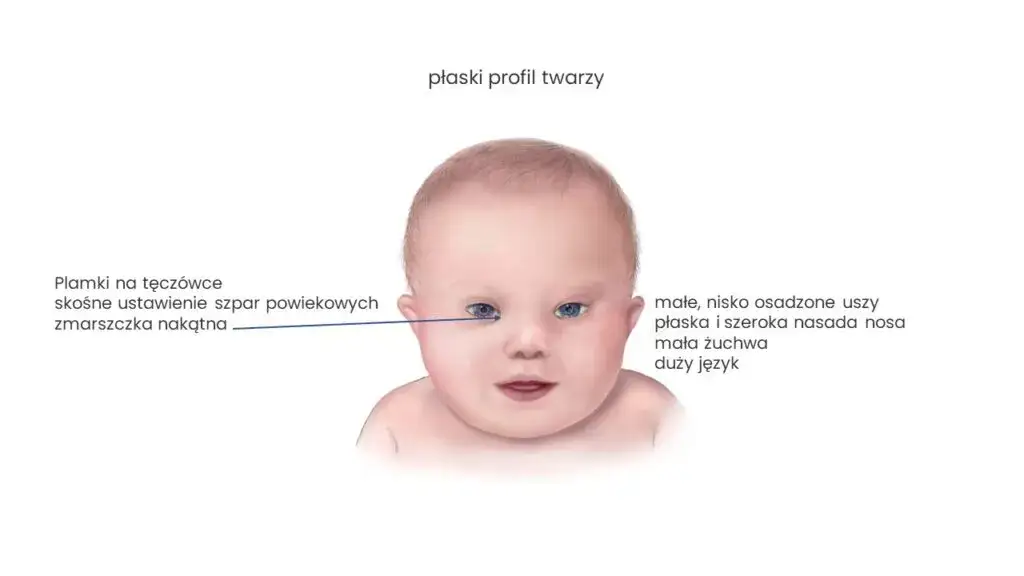 Kiedy wiadomo, że dziecko ma zespół Downa? Objawy i diagnoza