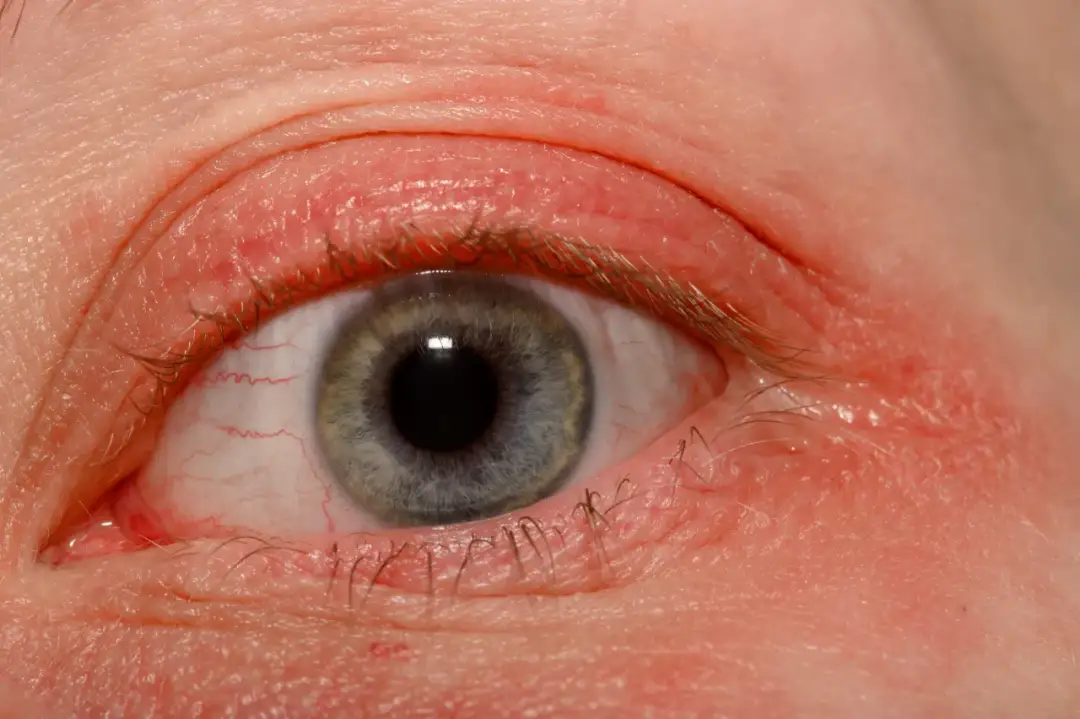 Alergia na klej do rzęs: Jak rozpoznać objawy i skutecznie działać?