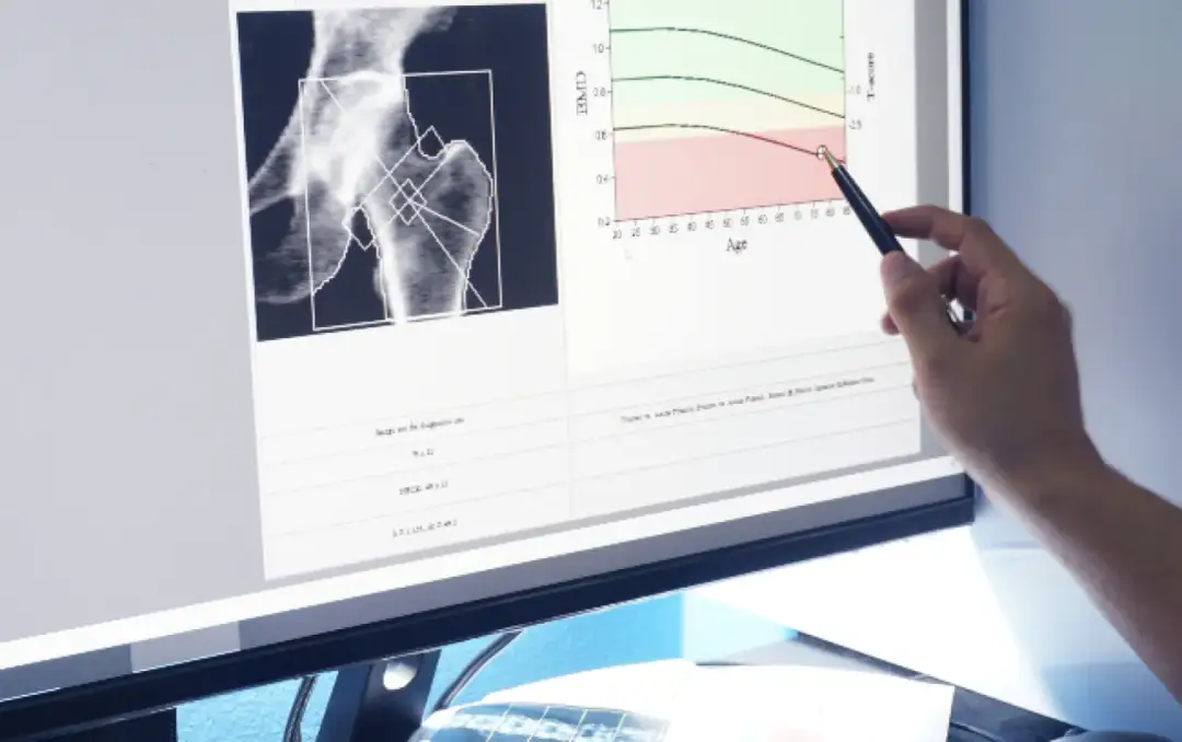 Die entscheidenden Schritte zur Osteoporose Diagnostik verstehen