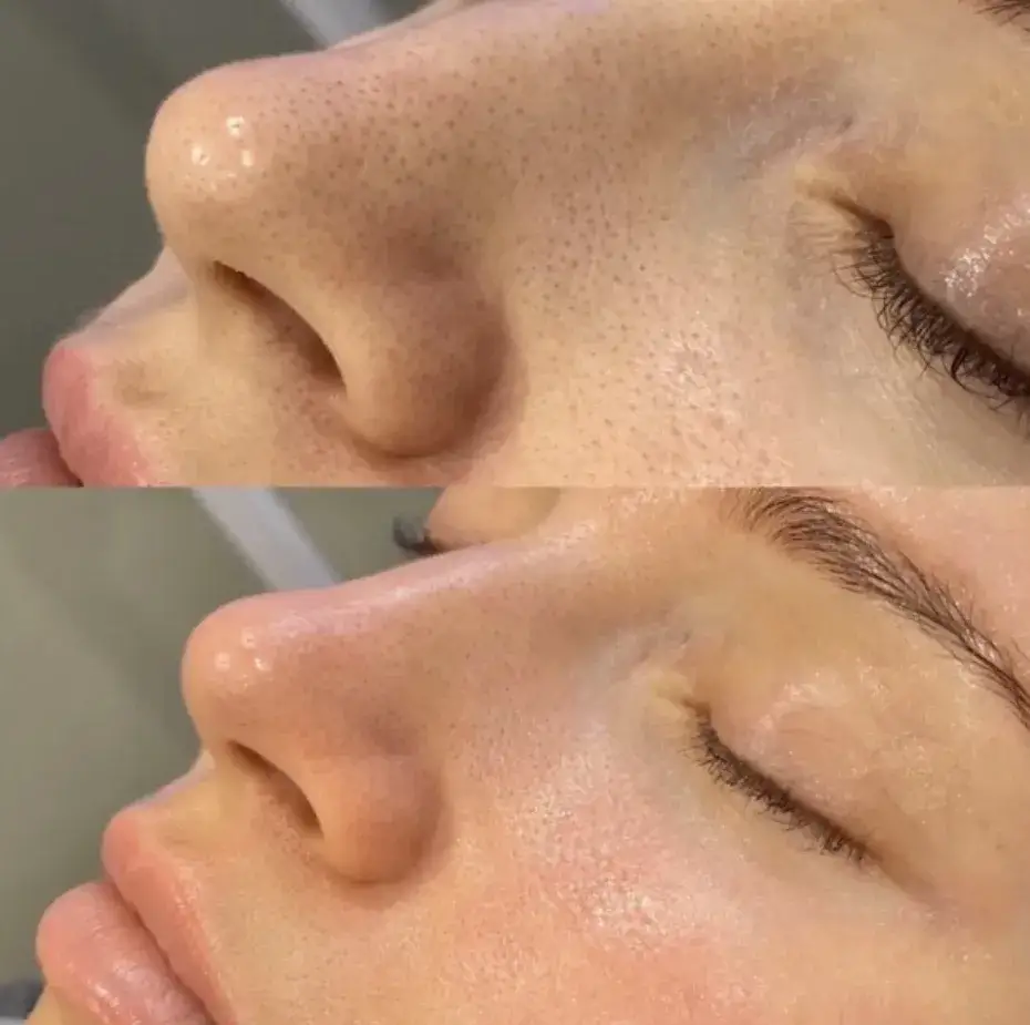 Mikrodermabrazja czy warto? Odkryj jej prawdziwe efekty i ryzyko