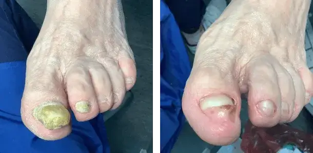 Martwy paznokieć: Co robić, by odzyskać zdrową płytkę?