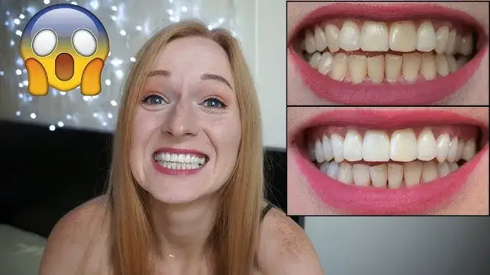 Jak wygląda wybielanie zębów? Efekty, metody i co warto wiedzieć