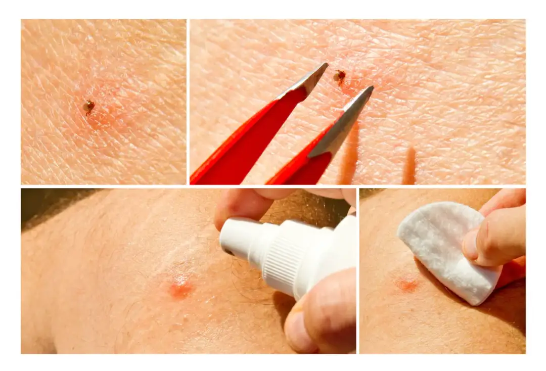 Czy ugryzienie kleszcza swędzi? Objawy i jak sobie z nimi radzić