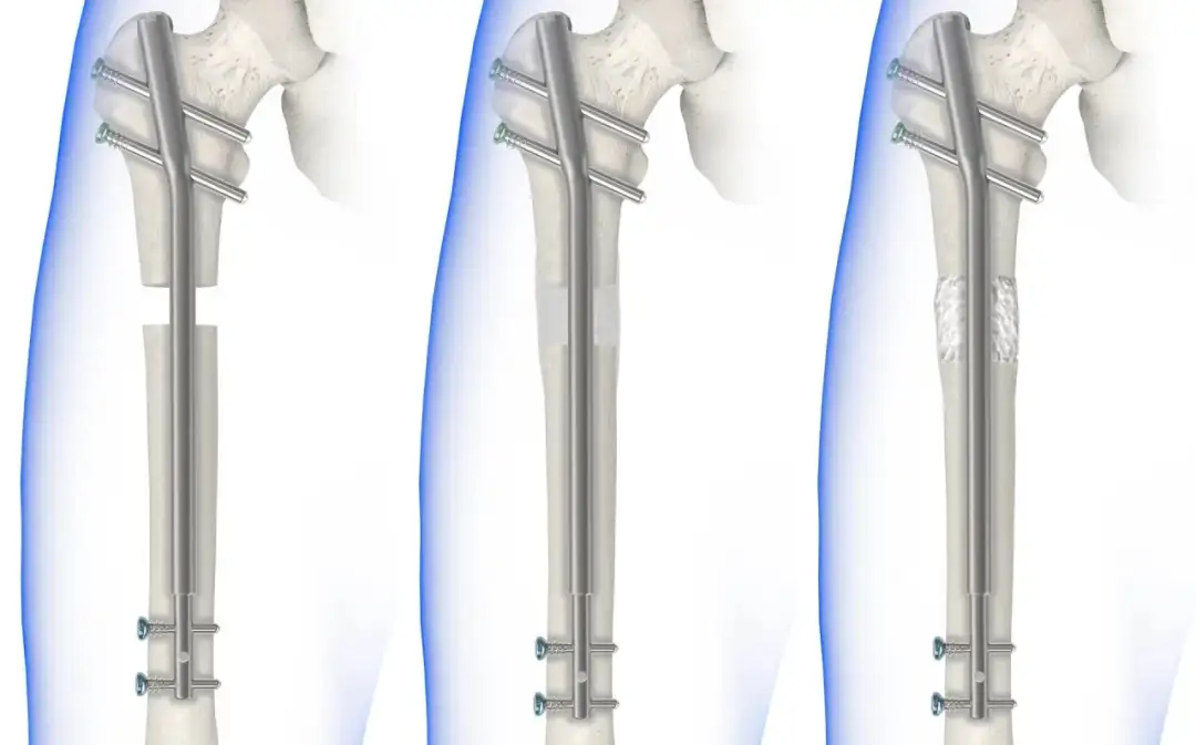 Rehabilitacja ud na czym polega: klucz do szybkiego powrotu do zdrowia