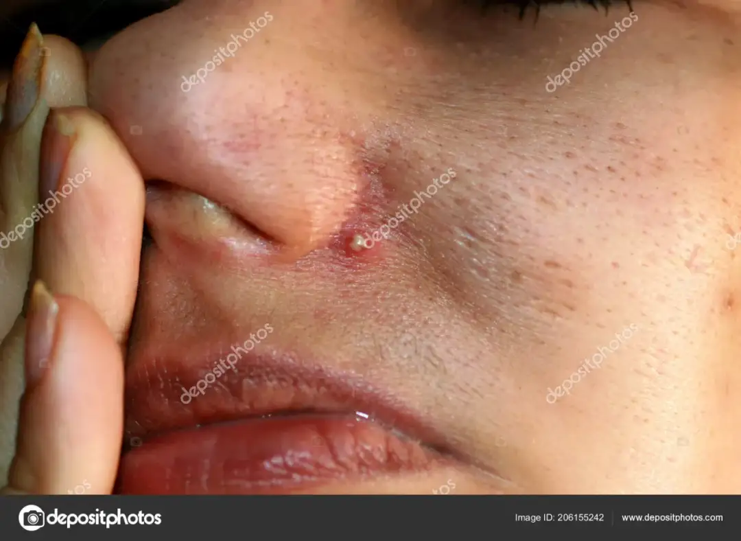 Pryszcz na nosie: Jak bezpiecznie usunąć i zapobiegać nawrotom?