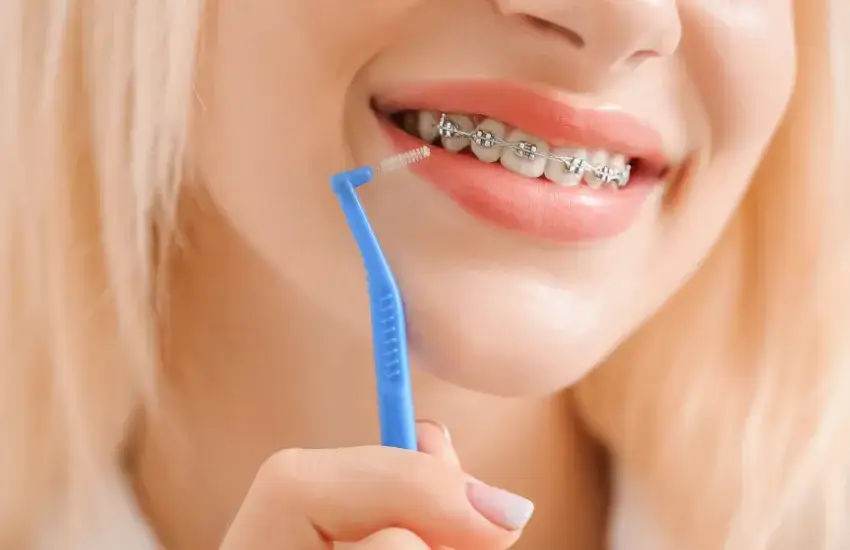 Jak czyścić aparat ortodontyczny, aby uniknąć próchnicy i problemów z dziąsłami