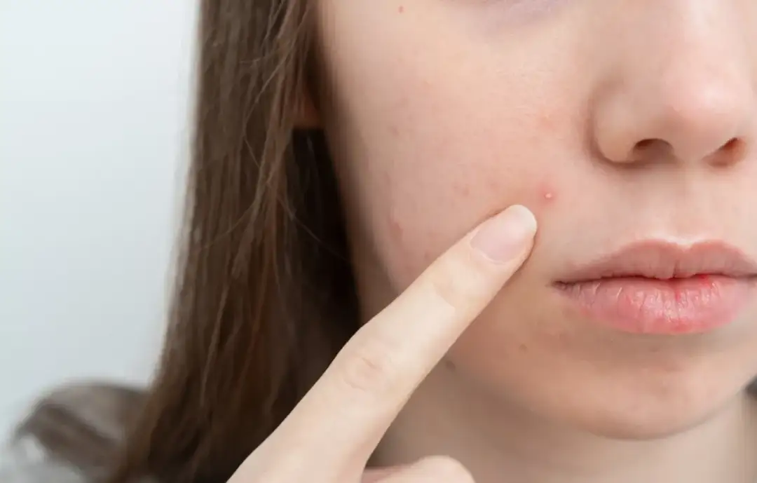 Jak wysuszyć pryszcza? Szybkie i skuteczne metody (domowe i z apteki)