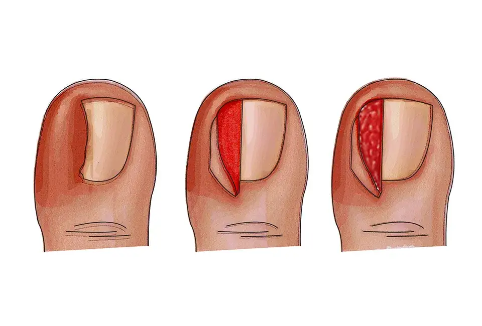 Jak pozbyć się wrastającego paznokcia - skuteczne metody i porady