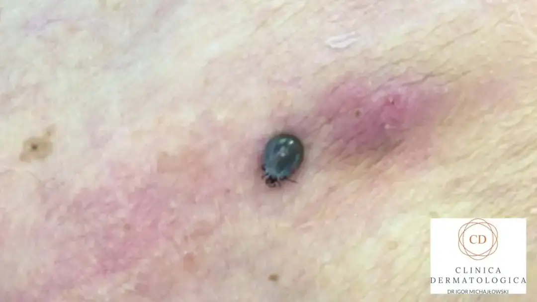 Opity kleszcz po 24h: Jak wygląda, co oznacza i jak go usunąć?