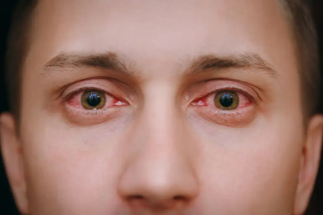 Zaczerwienione oczy przyczyna: poznaj najczęstsze powody i objawy