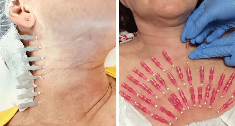 Zabiegi na szyję: Opinie i doświadczenia użytkowników forum