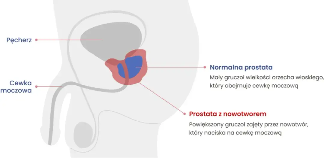 Choroba prostaty objawy - jak je rozpoznać i uniknąć powikłań