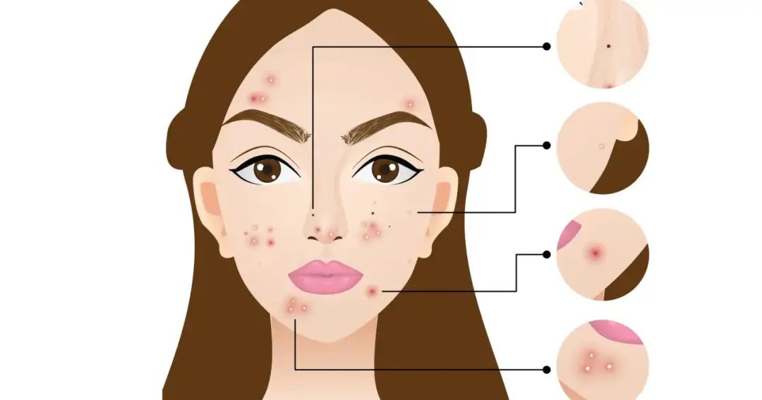 Dlaczego wyskakują pryszcze na twarzy? Poznaj przyczyny i rozwiązania