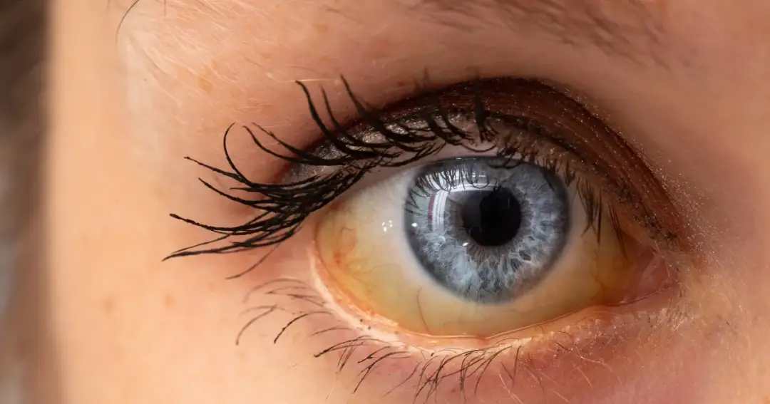 Skuteczne leczenie podwyższonego poziomu bilirubiny: metody i wskazówki