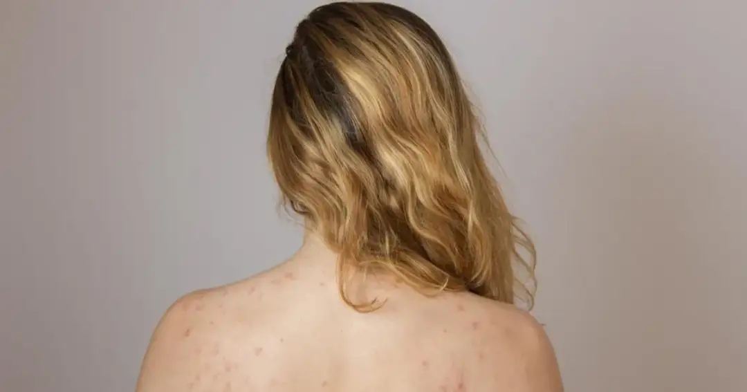 Dlaczego mam pryszcze na plecach? Odkryj przyczyny i skuteczne metody leczenia