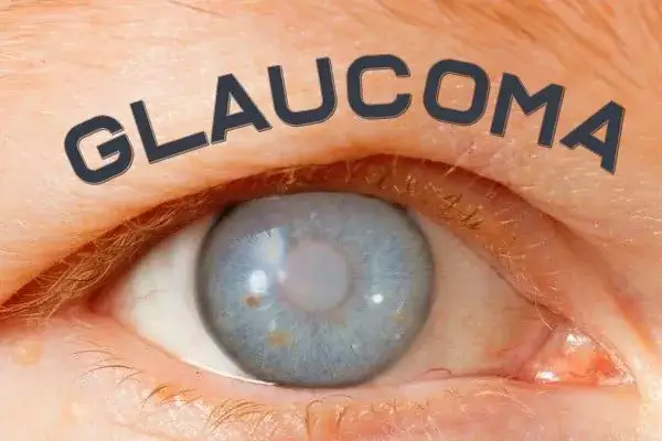 Síntomas de glaucoma: cómo reconocer señales de alerta y evitar la ceguera