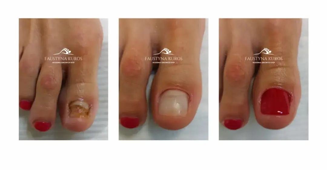 Uszkodzony paznokieć: Jak skutecznie go zregenerować i odbudować?