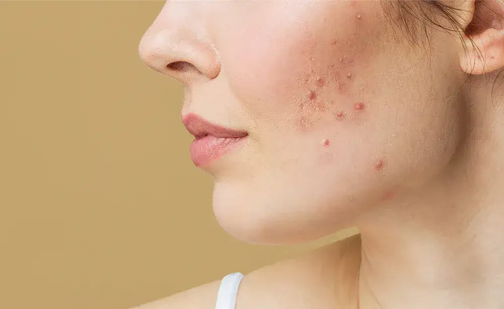Pryszcze w ciąży: Co bezpieczne? Składniki, których musisz unikać!