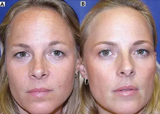 Botoks: Kiedy zobaczysz efekt "wow"? Harmonogram i trwałość