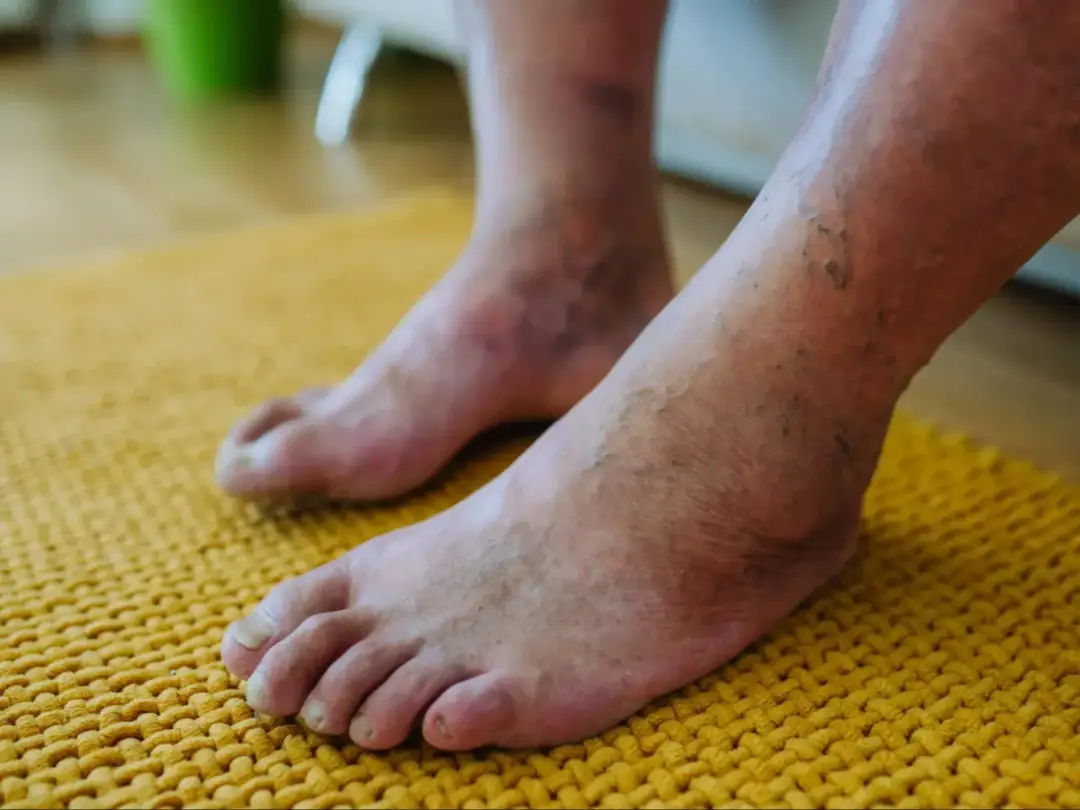 Jak leczyć stopę cukrzycową - Skuteczne metody i porady dla zdrowia