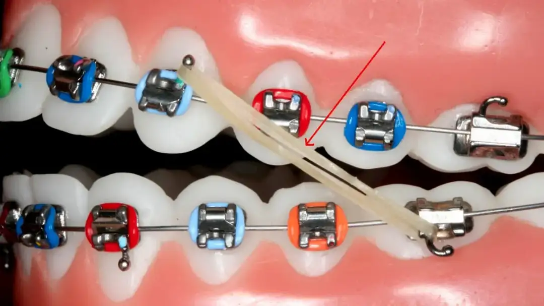 Jak zrobić sztuczny aparat na zęby bez ryzyka uszkodzenia zębów