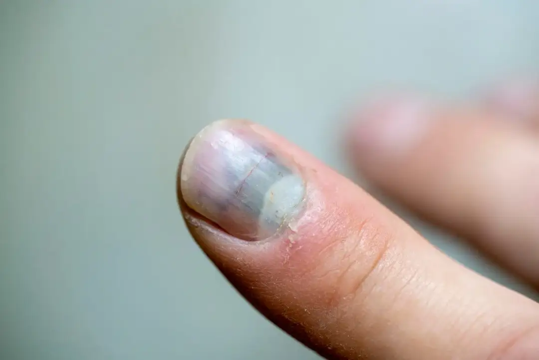 Uszkodzona macierz paznokcia: jak leczyć? Domowe i profesjonalne metody