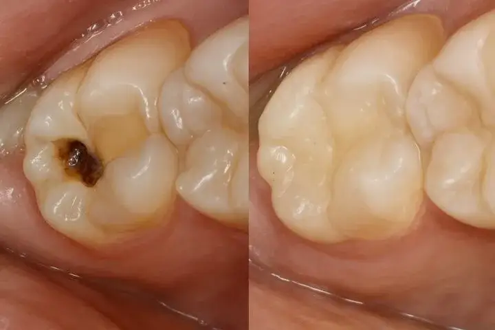 Wypadła plomba? Jak zabezpieczyć ząb i uśmierzyć ból