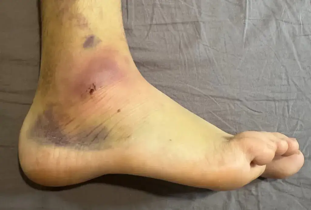 Skręcona kostka co robić: skuteczne metody na szybki powrót do zdrowia