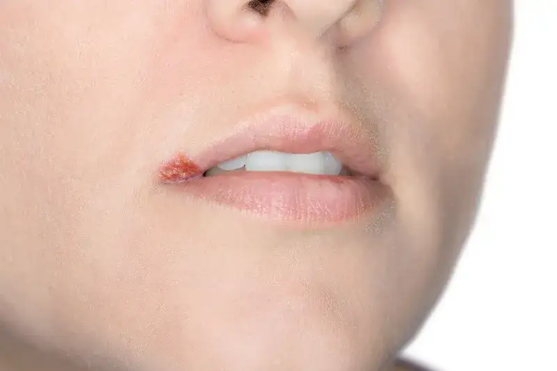 Czy można iść do dentysty z opryszczką? Sprawdź, jakie są ryzyka