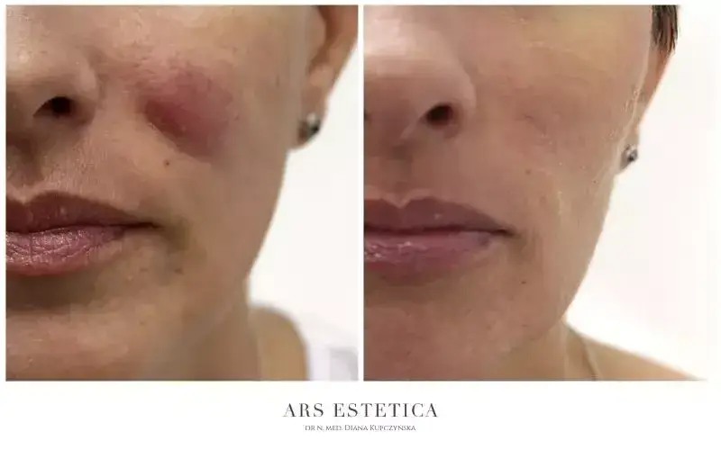 Opuchlizna po kwasie hialuronowym? Szybka ulga i sprawdzone triki