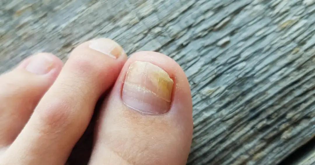 Co zrobić jak zejdzie paznokieć - skuteczne metody na ból i infekcję