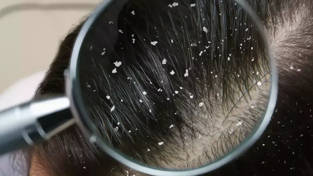 7 sprawdzonych sposobów na pozbycie się łupieżu raz na zawsze!