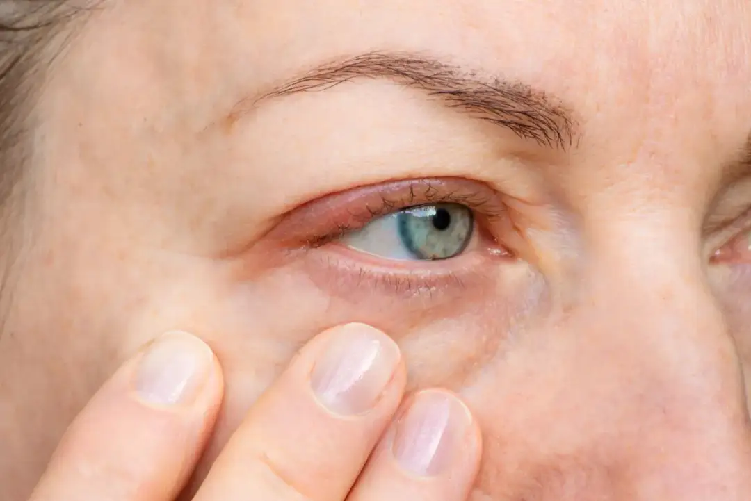 Opuchnięte oczy od alergii? Szybka ulga i domowe sposoby