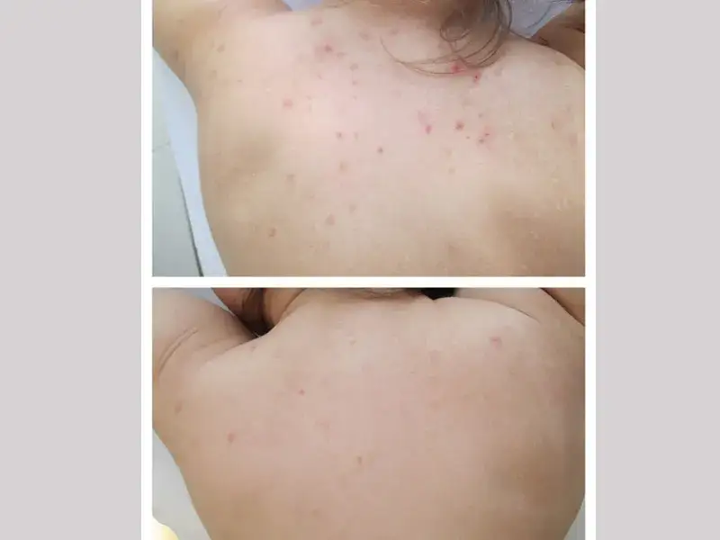 Jak usunąć przebarwienia po pryszczach? Kompletny przewodnik