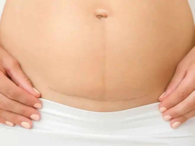 Kiedy ściąga się szwy po porodzie? Ważne informacje dla mam