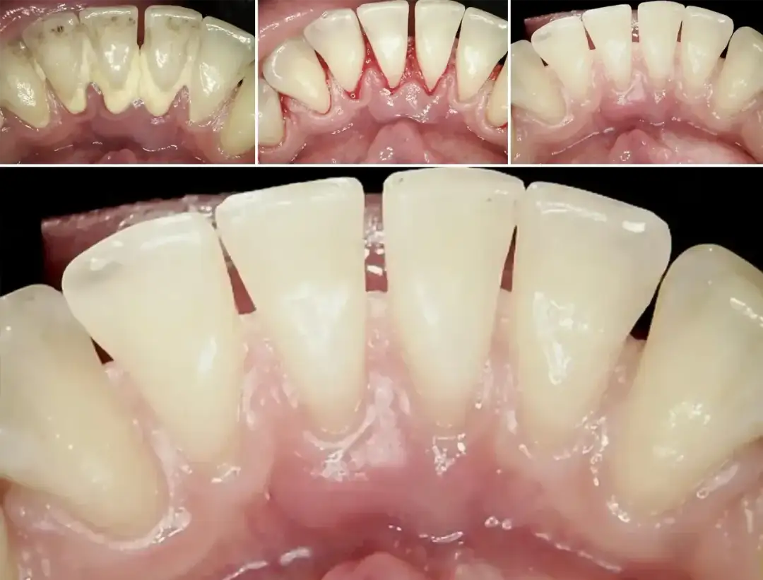 Zapalenie dziąseł: Ile trwa i jak szybko je wyleczyć?