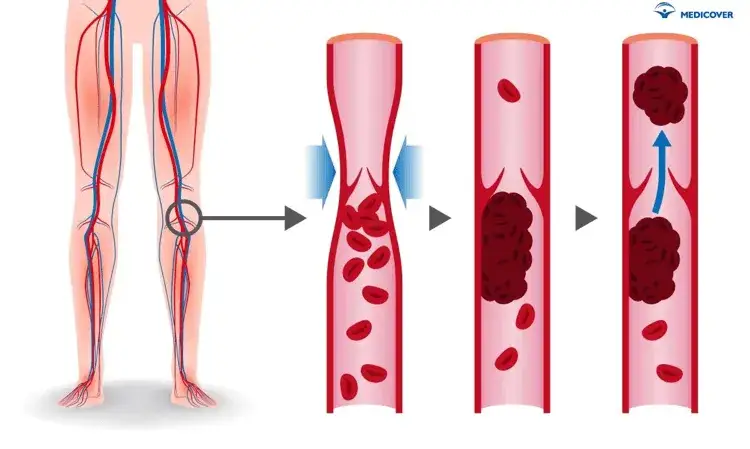 Zakrzepica żył: Leki, leczenie i dlaczego tylko na receptę?