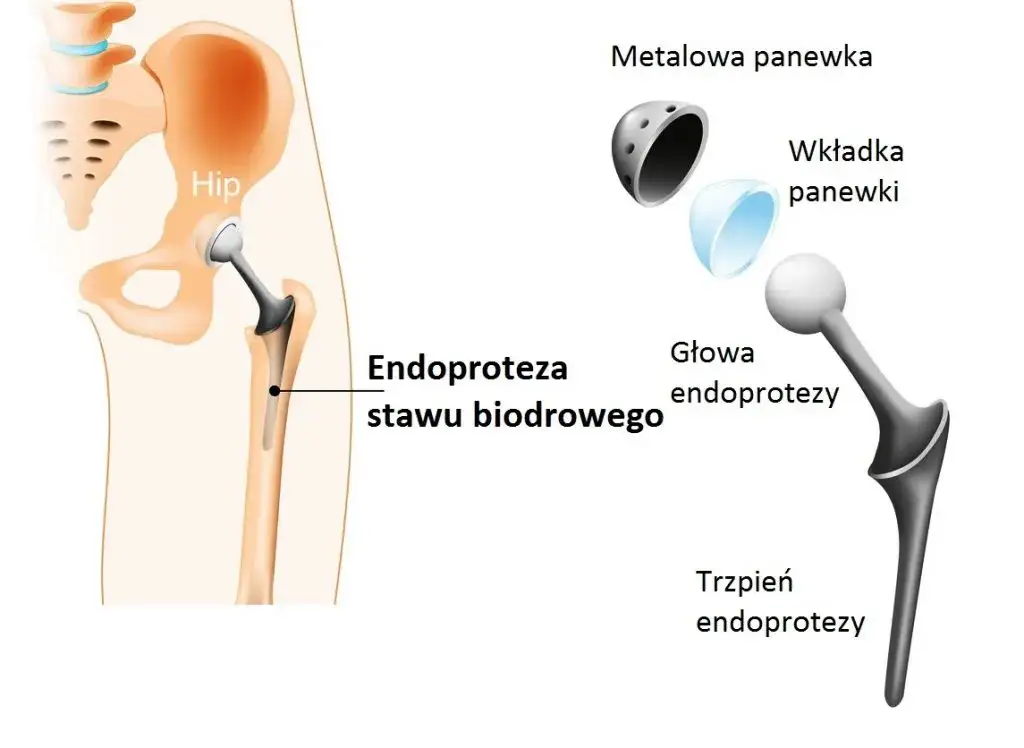 Ile kosztuje endoproteza stawu biodrowego w Niemczech? Ceny zaskakują
