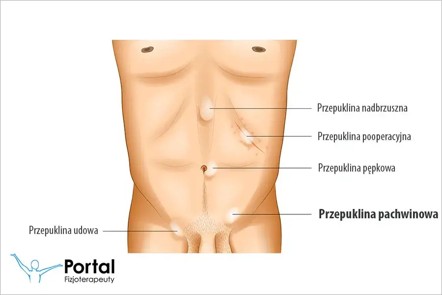 Badanie przepukliny pachwinowej - kompleksowa diagnostyka dla mężczyzn