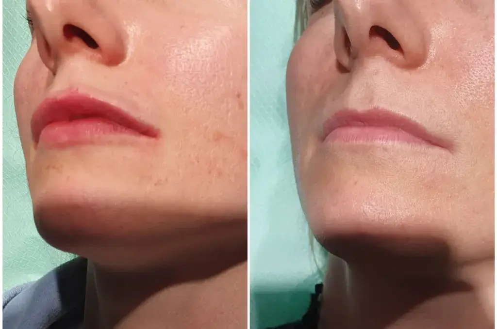 Powiększanie ust w Krakowie - gdzie znaleźć najlepsze kliniki?