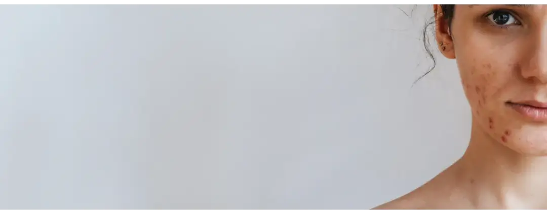 Jaki peeling do cery trądzikowej? Odkryj skuteczne rozwiązania dla skóry