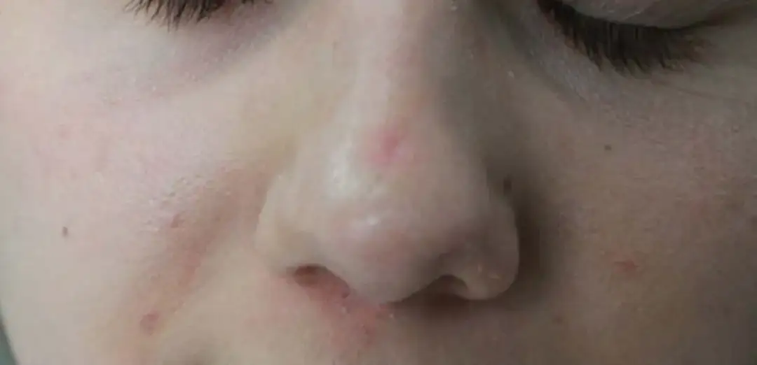 Jak szybko pozbyć się strupa po pryszczu i uniknąć blizn