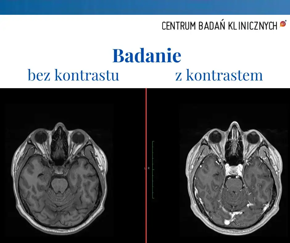 Skutki uboczne po podaniu kontrastu tomografii - co warto wiedzieć?