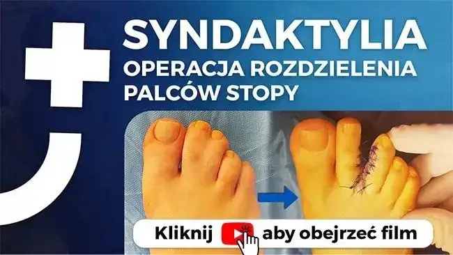 Zrośnięte palce u stóp: przyczyny, diagnostyka i leczenie