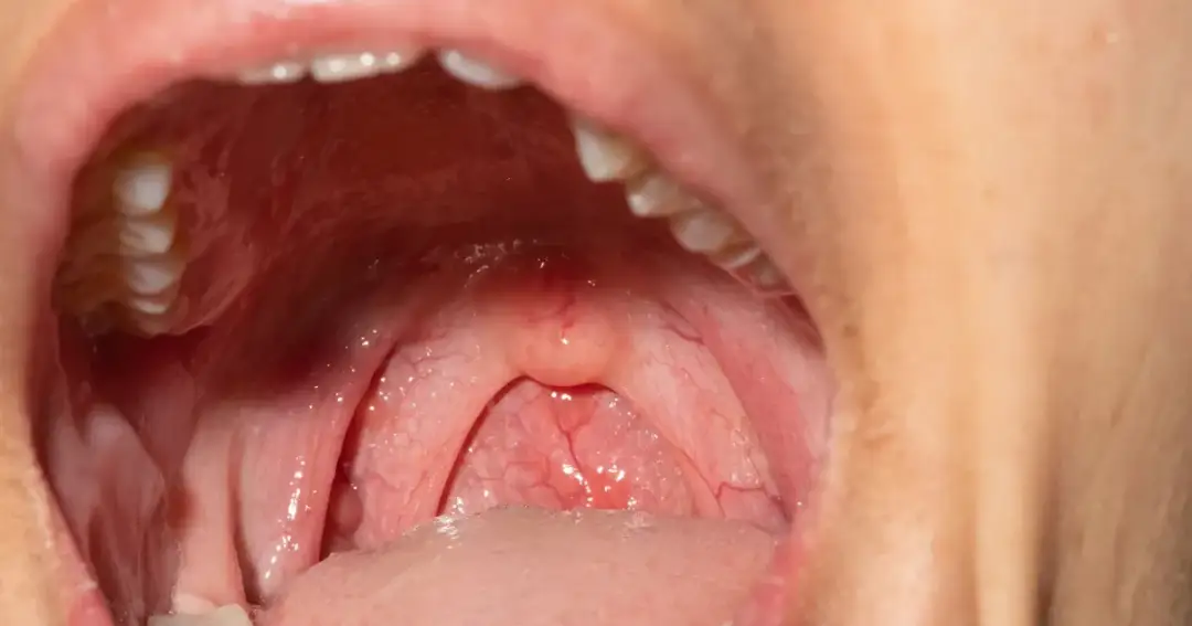 Jak skutecznie leczyć ból podniebienia i uniknąć dyskomfortu